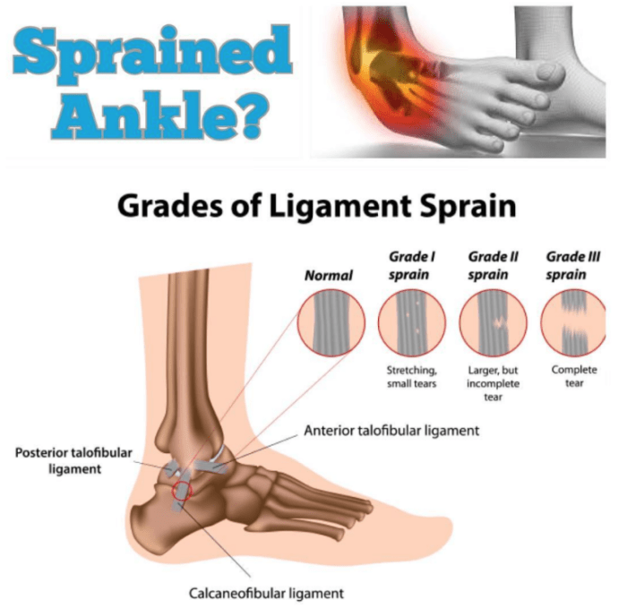 How to tell if you sprained your ankle quiz