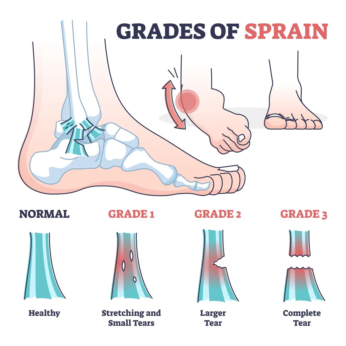 Ankle sprain sprains grade ligament injury vejthani sprained tear เท ligaments collateral