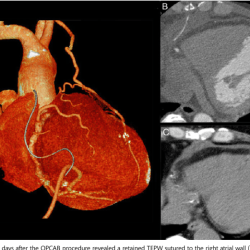 Epicardial wires removal chest pain left side