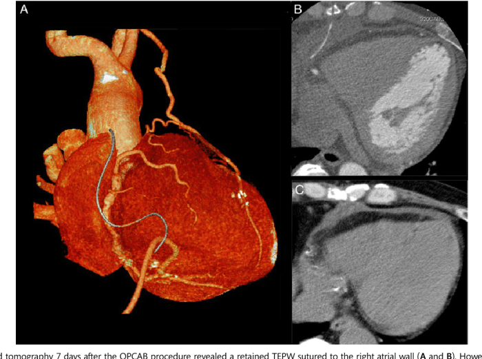 Epicardial wires removal chest pain left side