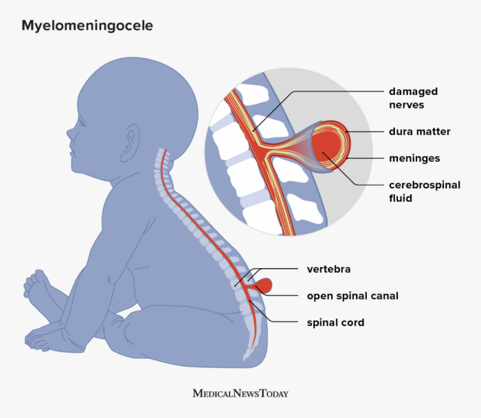 Translate the medical term myelomeningocele as literally as possible