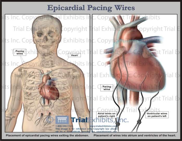 Epicardial wires removal chest pain left side