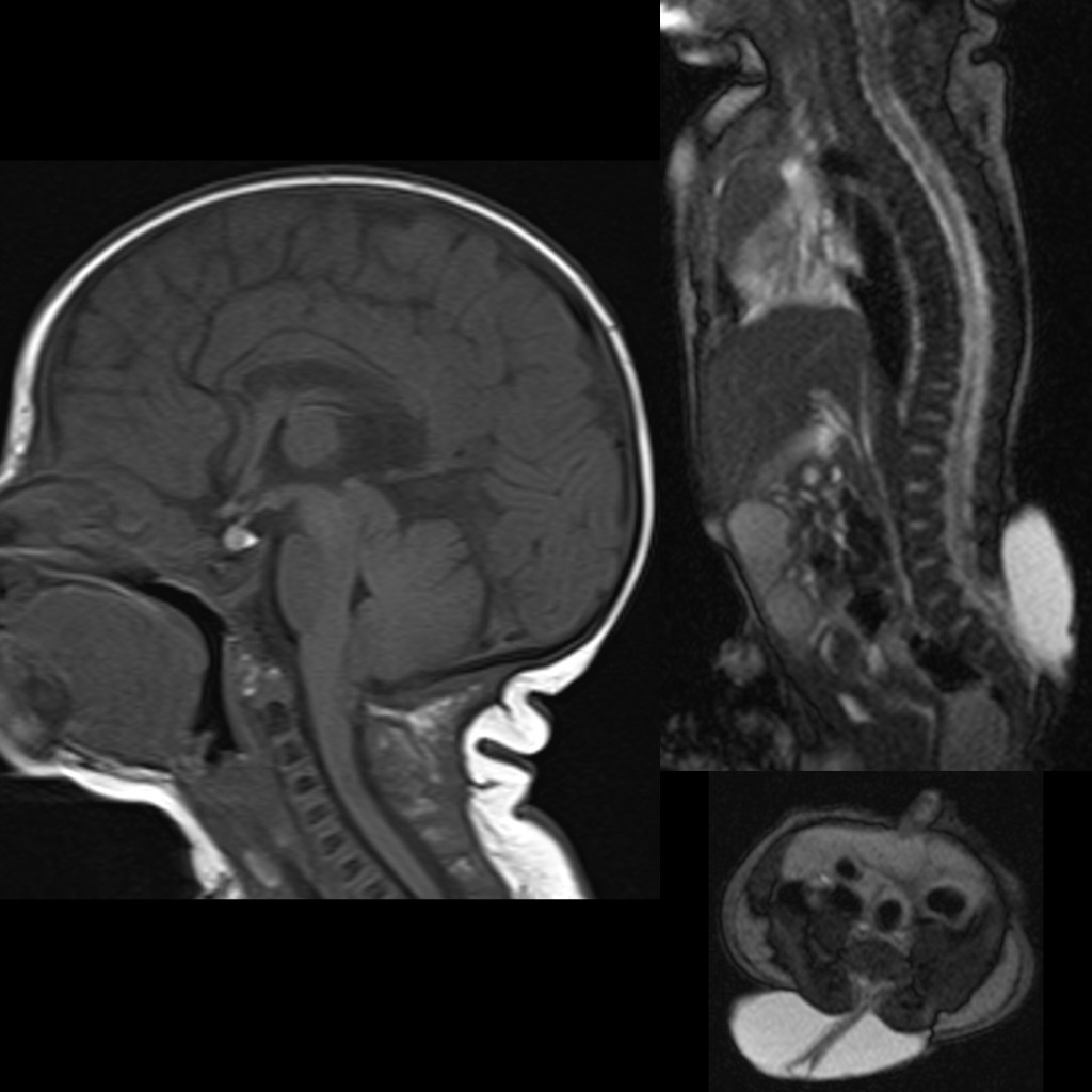 Translate the medical term myelomeningocele as literally as possible