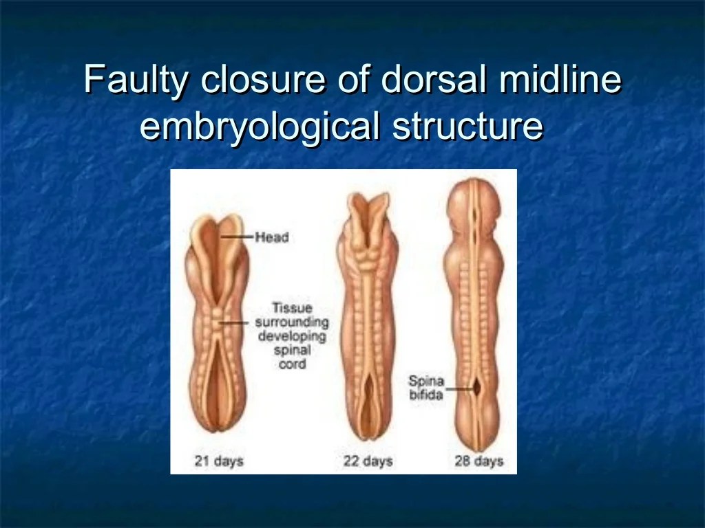 Myelomeningocele spina bifida